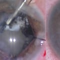 Is it ok to vacuum after cataract surgery?