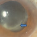 Preventing Endophthalmitis After Cataract Surgery: What You Need to Know