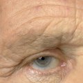 Will both eyes be the same after cataract surgery?