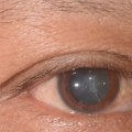 What Are he Most Common Problems After Cataract Surgery?