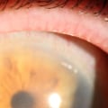 What Should I Be Worried About After Cataract Surgery?
