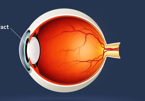 What are the Symptoms of a Botched Cataract Surgery?