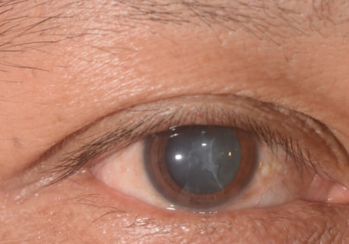 How long is careful after cataract surgery?