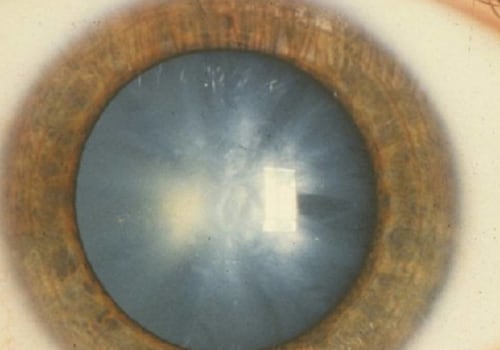 Is cataract surgery worth the risk?