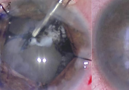 Is it ok to vacuum after cataract surgery?