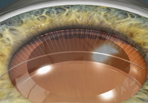 What is the Safest Type of Cataract Surgery?