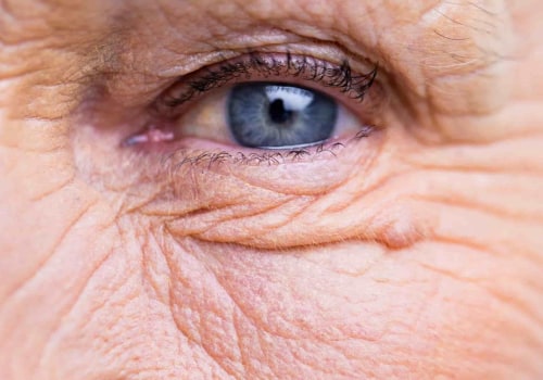 How Long Does It Take to Recover from Cataract Surgery?