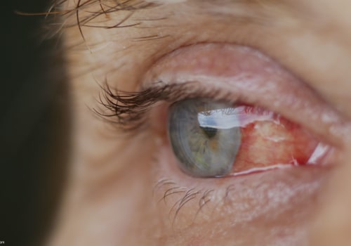 What is the most common complication after cataract surgery?
