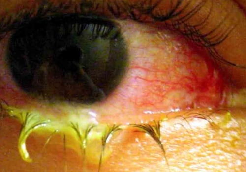 How quickly can you get an eye infection?