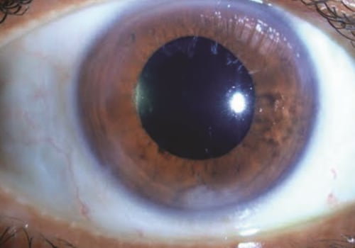 What to Expect in the Weeks After Cataract Surgery