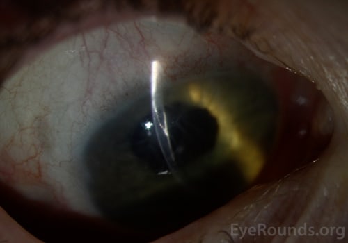 What Are the Abnormal Symptoms After Cataract Surgery?
