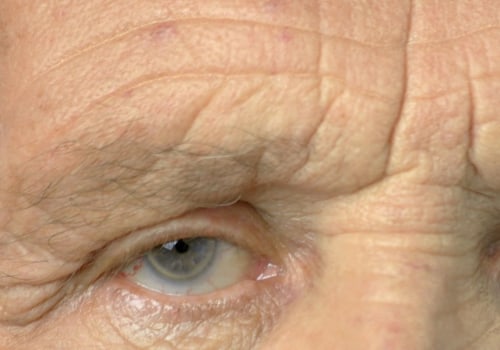 Will both eyes be the same after cataract surgery?