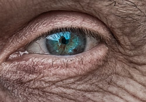 What is a grade 3 cataract?