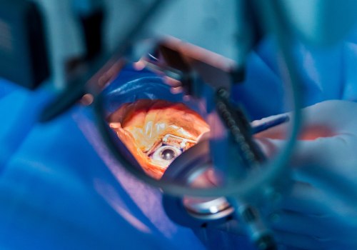 What Do You See During Cataract Surgery?