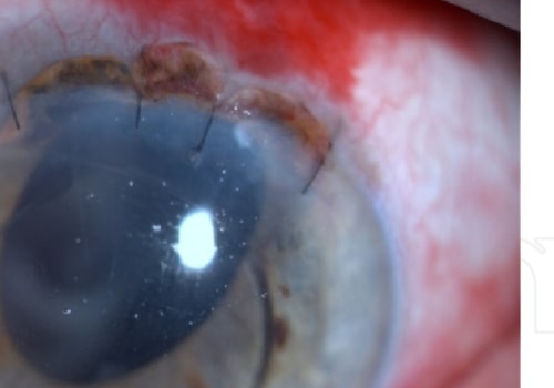 What are the Most Common Complications of Cataract Surgery?