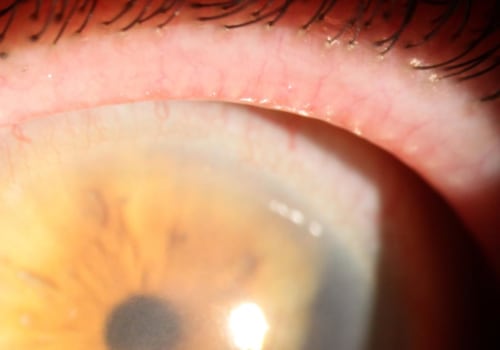 When Should I Be Concerned After Cataract Surgery?