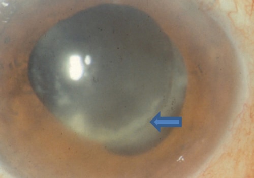 How do you know if you have an infection after cataract surgery?