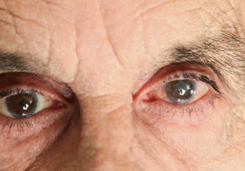 What to Expect from Cataract Surgery